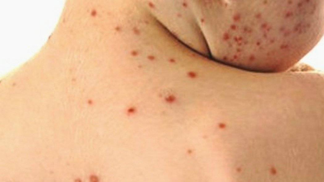 Morbillo, casi triplicati quest’anno. Allarme dell’Oms