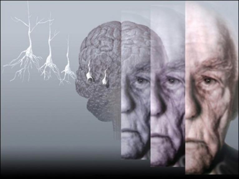 Folli sperimentazioni di farmaci su malati di Alzheimer in Francia